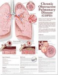 Chronic Obstructive Pulmonary Disease Anatomical Chart 2nd  Ed
